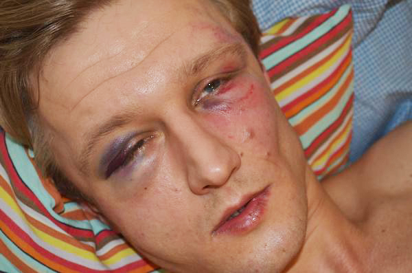 Vasyl Cherepanyn received severe facial injuries Photo via: VCRC’s Facebook page