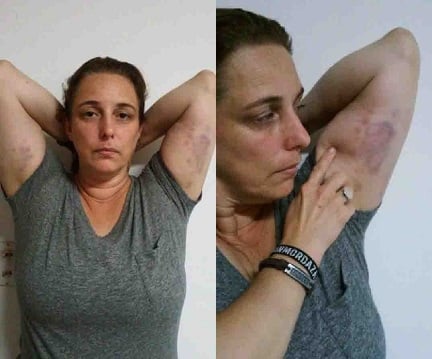 Tania Bruguera displays bruises sustained during her latest arrest. Photos via Facebook.