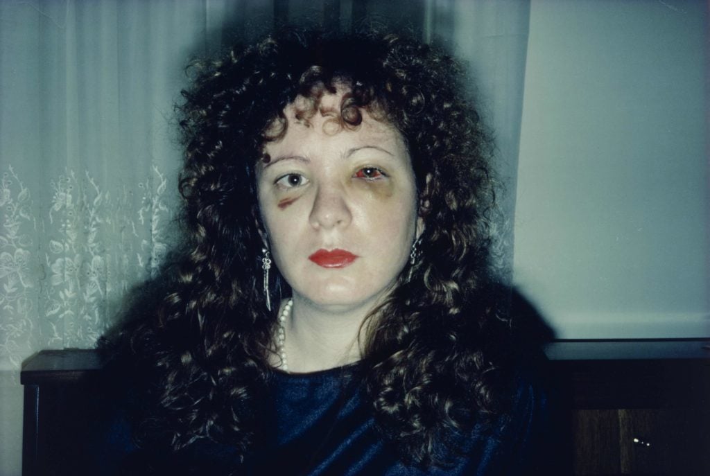 Nan Goldin, Nan One Month After Being Battered (1984). Courtesy of the Museum of Modern Art, New York, © 2016 Nan Goldin