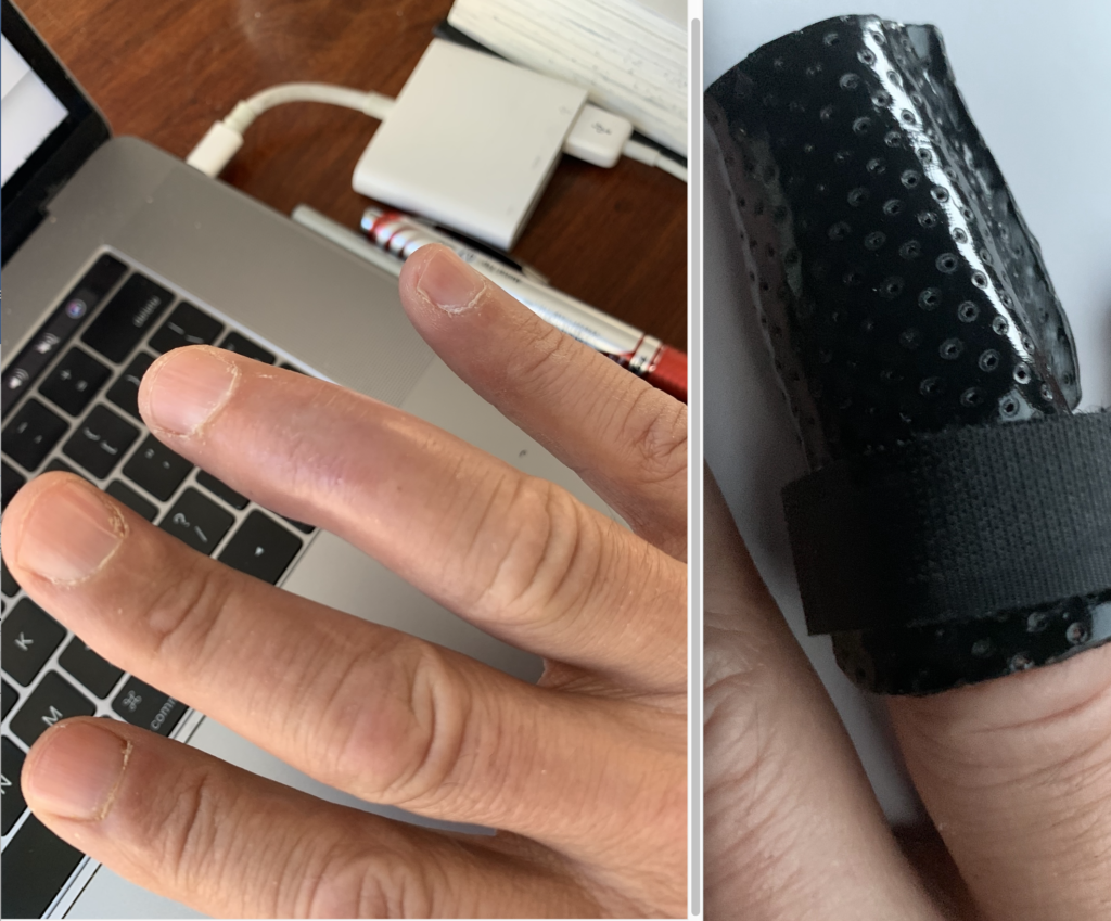 Art is a dangerous game. The sacrifices I make for my readers, setting back the healing of my tendon-tear rehabilitation to facilitate typing. Courtesy of Kenny Schachter.