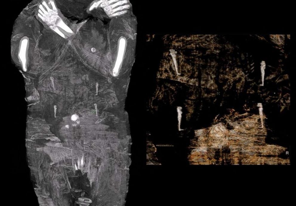The world's first pregnant mummy, as seen in scans. Photo courtesy of the Warsaw Mummy Project. 