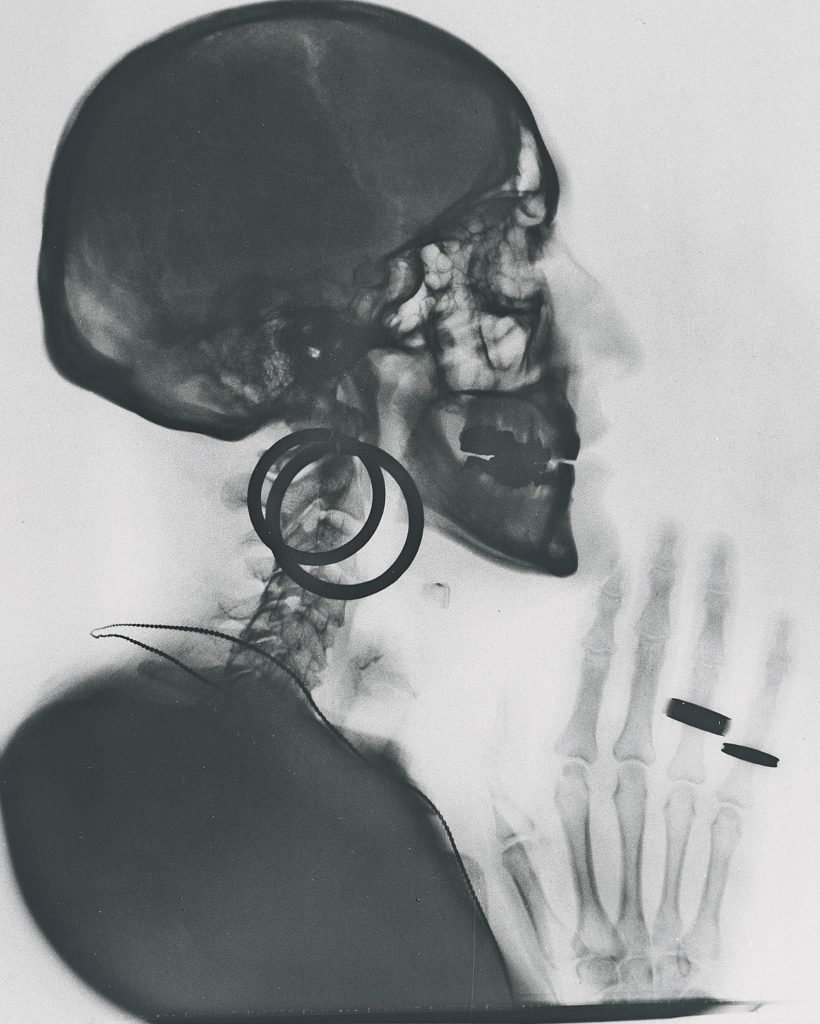 Meret Oppenheim, X-ray of MO's skull (Röntgenaufnahme des Schädels MO).  (1964/1981).  Hermann and Margrit Rupf Foundation.  Bern Kunstmuseum.