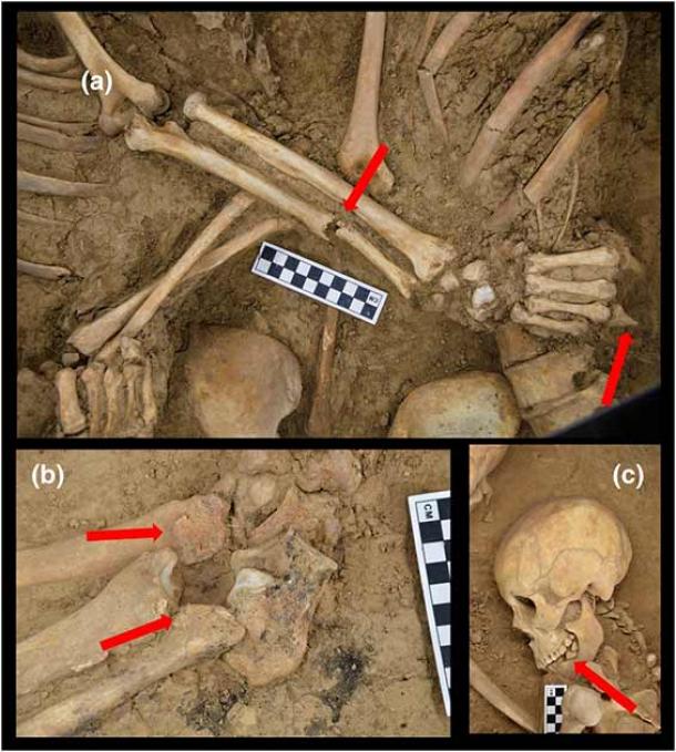 Pathological and trauma signs on the lovers’ skeletons: (a) An unhealed ulnar fracture and missing part of the fourth digit on the right hand of the male individual. Slight development of the marginal osteophytes on the lumbar vertebrae could be detected in the female skeleton; (b) Osteophytosis on the distal end of the lower limbs of the male individual; (c) Antemortem tooth loss in the female individual. Photo courtesy of the International Journal of Osteoarchaeology.