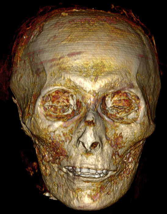 The pharaoh's skull, including his teeth in good condition. Courtesy of S. Saleem and Z. Hawass.