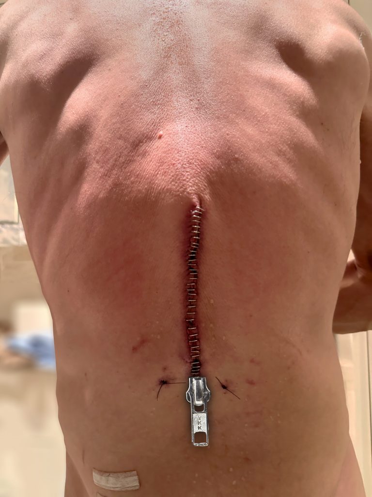A digitally altered color photo shows a zipper atop a large scar